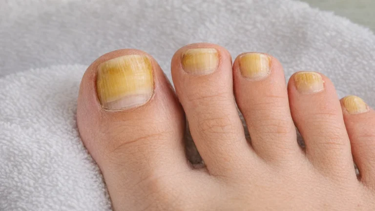 Ongles des pieds jaunes et épaissis sur gros orteil pouvant évoquer une mycose unguéale ou un jaunissement de l’ongle