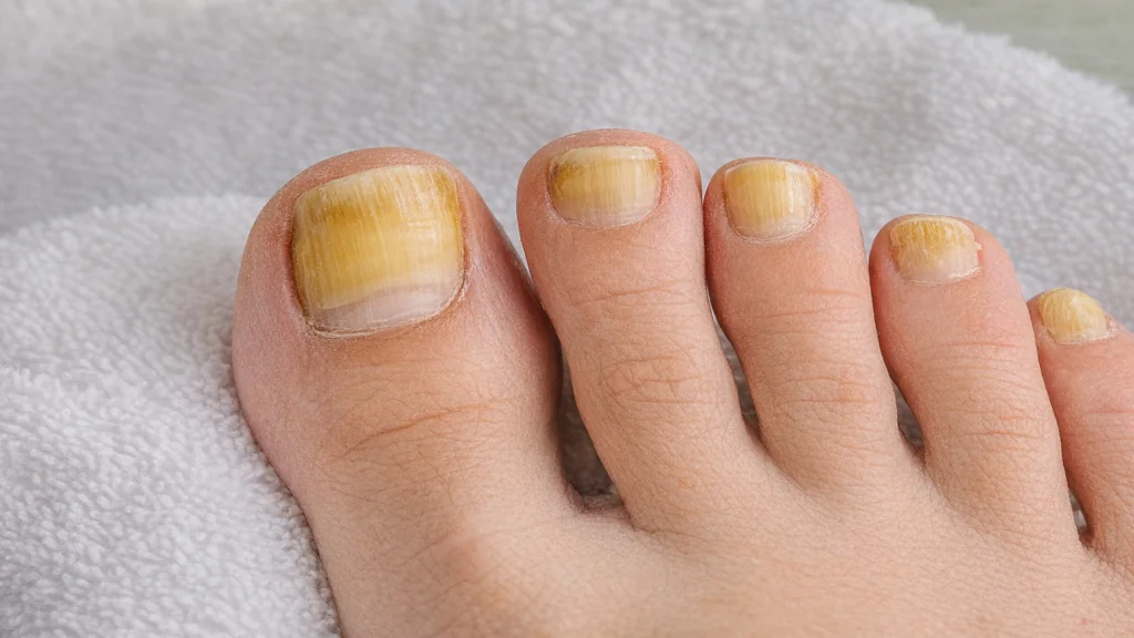 Ongles des pieds jaunes et épaissis sur gros orteil pouvant évoquer une mycose unguéale ou un jaunissement de l’ongle