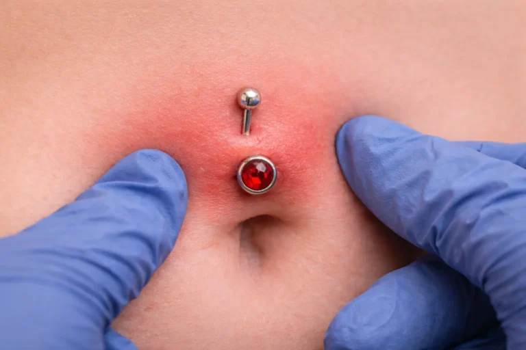 Piercing au nombril rouge et enflammé examiné avec des gants médicaux, illustrant les signes d’une infection du piercing au nombril.