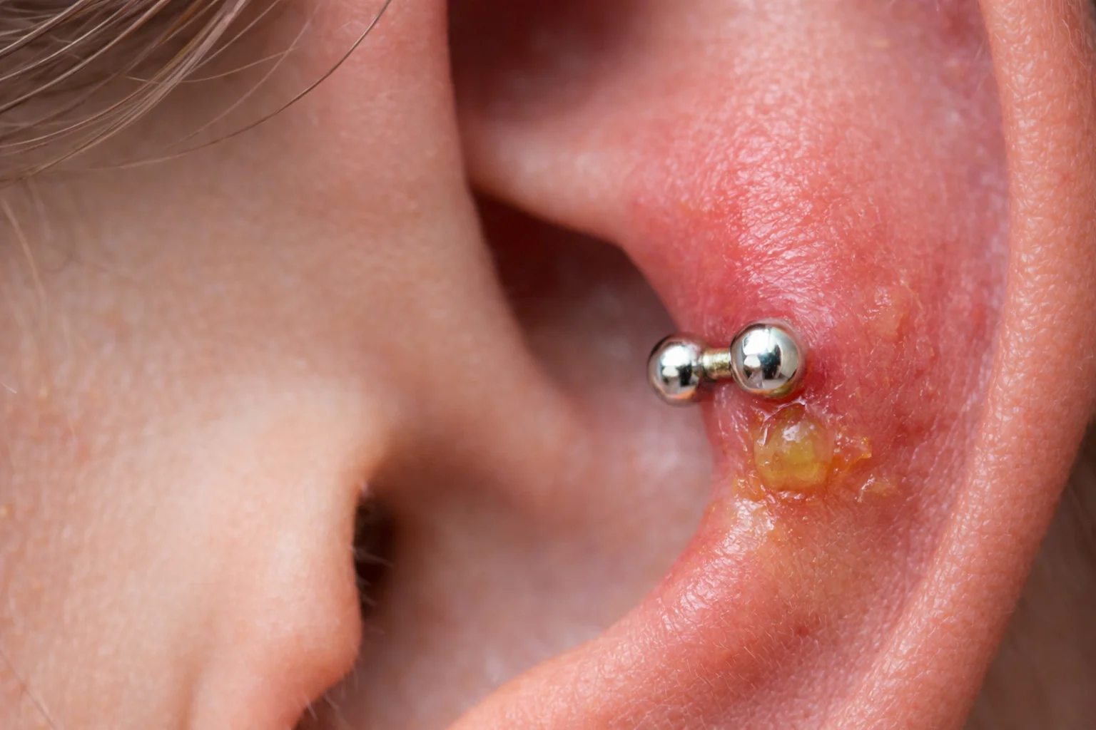 Gros plan réaliste d’un piercing oreille infecté avec rougeur, gonflement et présence de pus autour du bijou