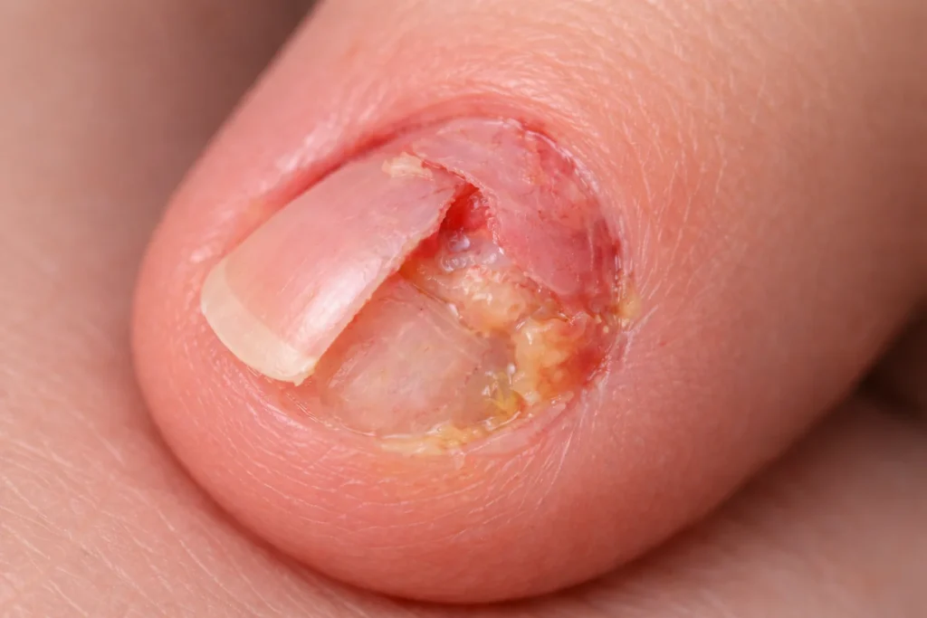 Gros plan réaliste d’un ongle abîmé à la base avec matrice fragilisée, légère rougeur et repousse irrégulière.