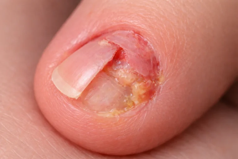 Gros plan réaliste d’un ongle abîmé à la base avec matrice fragilisée, légère rougeur et repousse irrégulière.