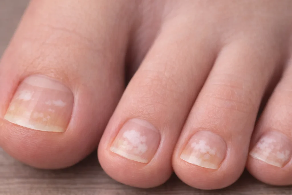 Gros plan d’ongles de pieds avec taches blanches visibles sur la surface, illustrant une leuconychie ou un traumatisme de l’ongle.